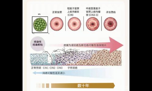 宫颈腺癌晚期死亡案例-宫颈腺癌晚期转移了能活多久专区_宫颈腺癌晚期死亡案例专区_宫颈癌晚期病人腺癌网